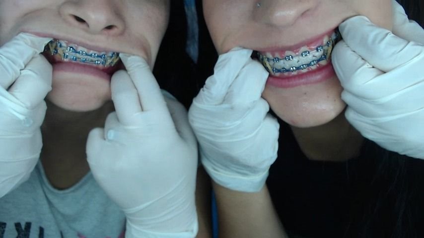 Miaisabella3 Mouth Teeth Braces Inspection